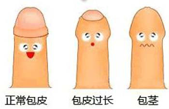 怎样才算包皮过长?