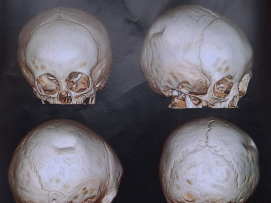 婴幼儿颅骨骨折特点